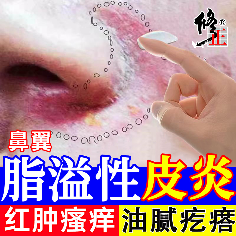 无激素草本鼻翼脂溢性皮炎膏