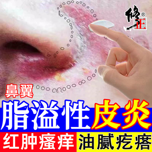 鼻翼脂溢性皮炎面部面霜鼻子两侧发红脱皮油脂两边泛红干燥起皮TT