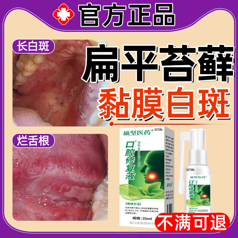 口腔扁平苔藓专用治黏膜修复扁平苔癣白斑纤维化口腔溃疡糜烂PP
