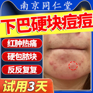 下巴反复脸颊两边长痘内分泌调理失调脓包痤疮搭火疖子膏儿童LL