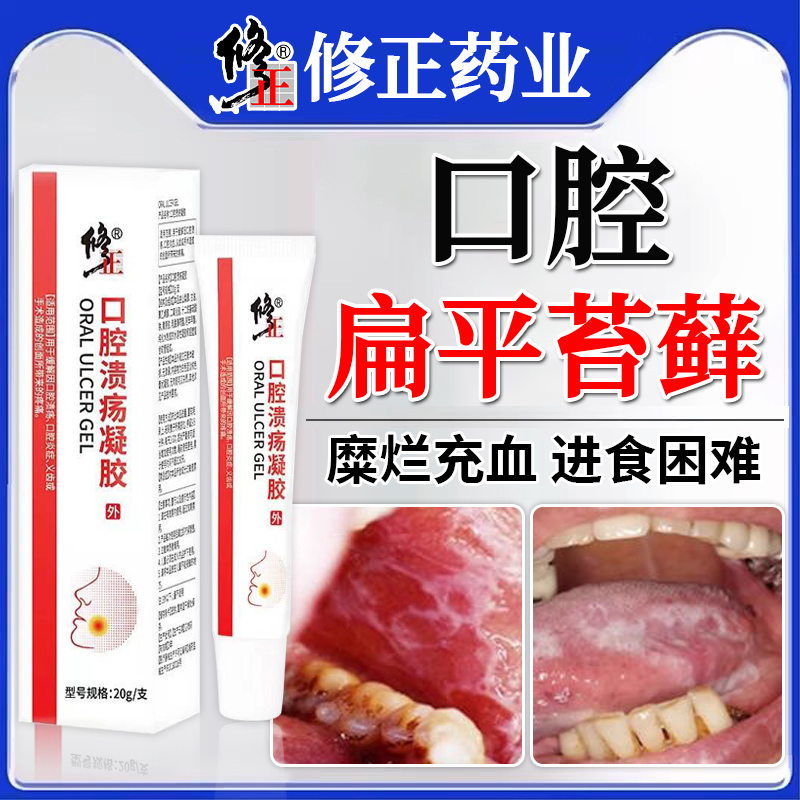 口腔扁平苔藓专用药治疗黏膜修复白斑液药膏纤维化口疮溃疡充血GX