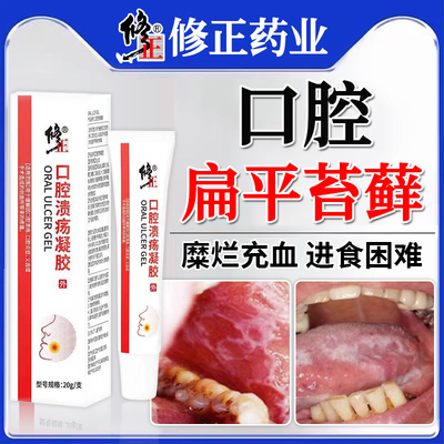 口腔扁平苔藓专用治疗黏膜修复白斑液膏纤维化口疮溃疡充血GX