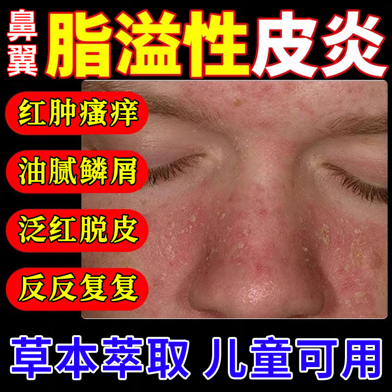 鼻翼脂溢性皮炎面部面霜鼻子两侧发红脱皮油脂两边泛红干燥起皮TT