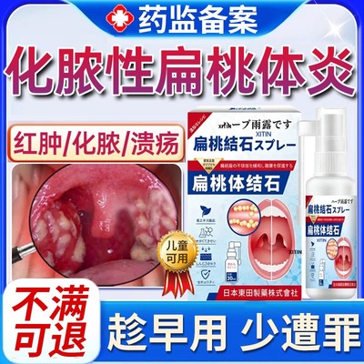 急性化脓性扁桃体炎专用喷雾剂喉咙肿痛扁桃体炎用的嗓子疼红肿WY