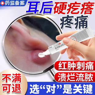 耳后鼓包长硬块痘疙瘩皮脂腺囊肿粉瘤疖肿拔毒拔脓专用火疖子UU
