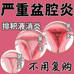 慢性盆腔炎热敷包中药贴栓剂盆腔积液调理偏方妇科用药凝胶灌肠UU
