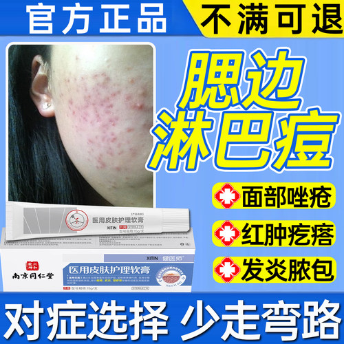 淋巴痘腮边痘专用膏下巴脖子反复长痘痘痤疮脸颊下颚长结节硬块WY