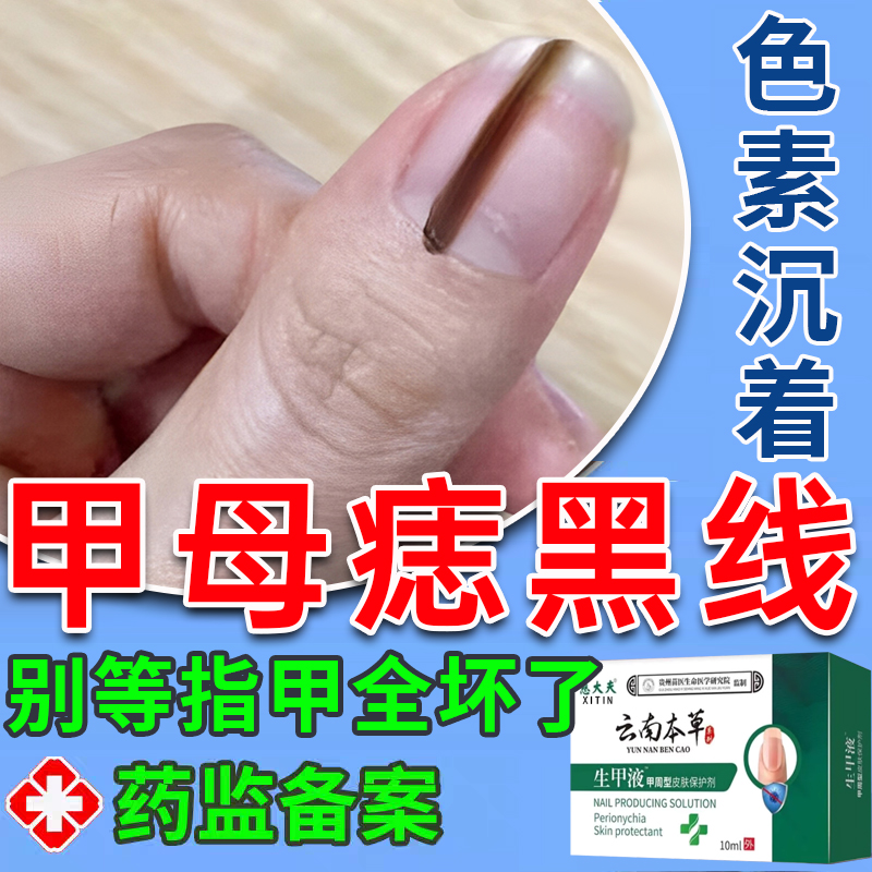 甲母痣黑线指甲长黑色竖纹药膏阿莫药水黑灰指甲罗芬开裂搽剂UU