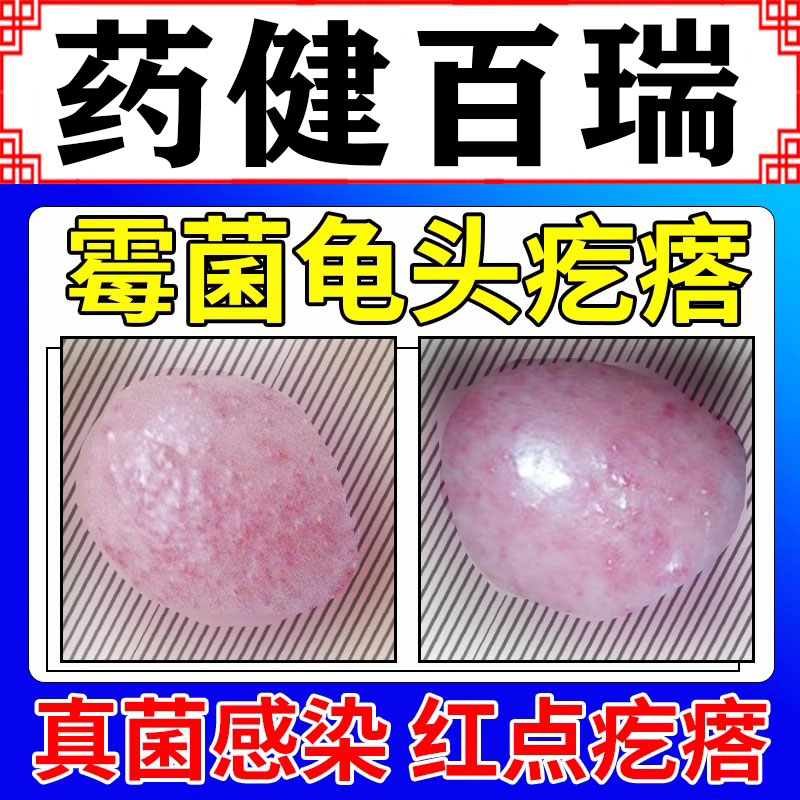 男性龟头炎真菌感染霉菌型症专用可搭念珠菌性红点疙瘩小颗粒gx
