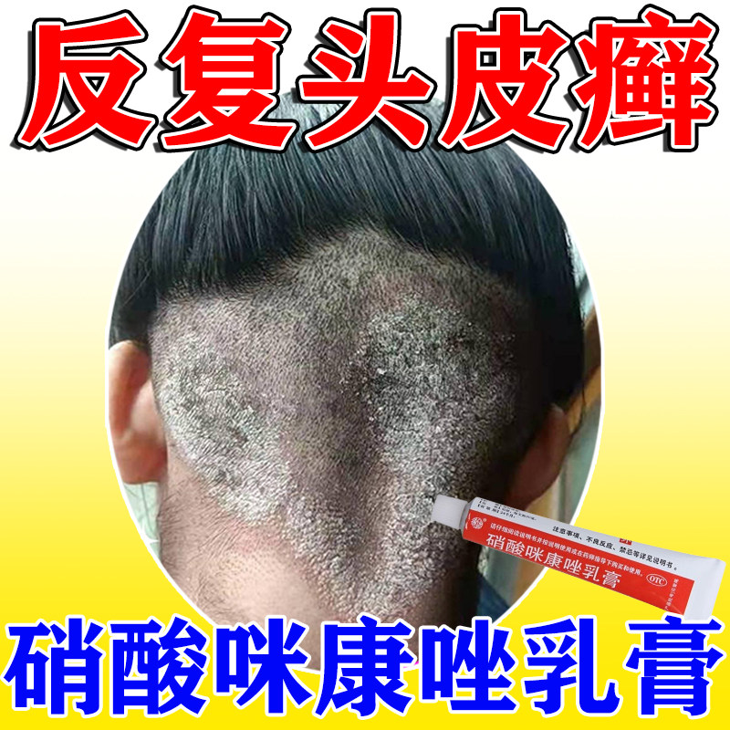 头癣软膏治头皮癣真菌感染头部起癣硝酸咪康唑乳膏正品