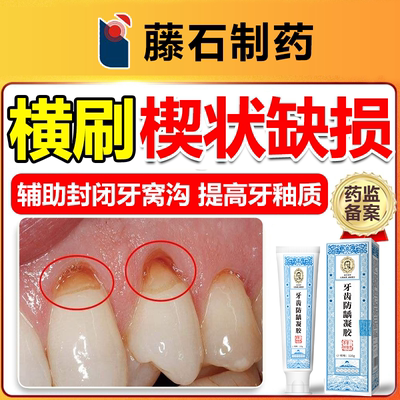 牙齿楔状缺损修补牙膏护龈固齿