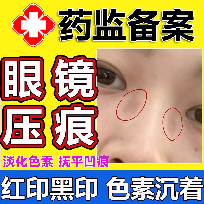 去鼻梁眼镜压痕消红黑印除黑色素沉淀白愈康净乳膏凝胶神痘疤器wg