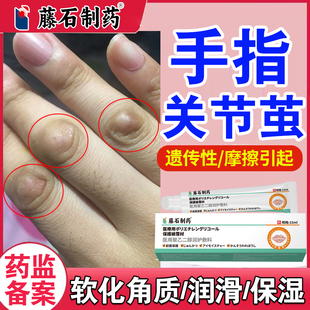 手指关节茧胼胝皮肤增厚老茧药监备案膏软化手上长硬疙瘩指节垫xj