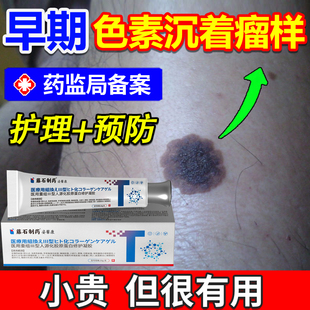 黑色素瘤早期恶性疗搭药膏血管瘤血管痣淡化黑色素痣去除治凝胶xj
