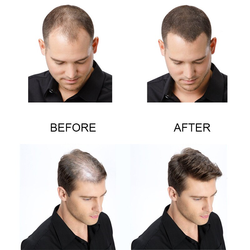 极速PURC 5PCS Hair Growth Products FasIt Growing Hair Oil Ha