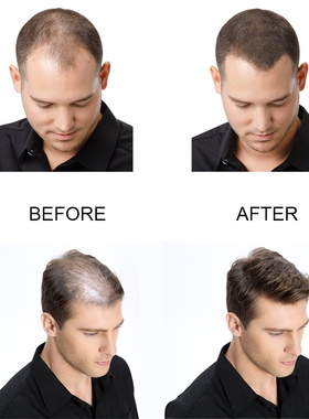 极速PURC 5PCS Hair Growth Products FasIt Growing Hair Oil Ha