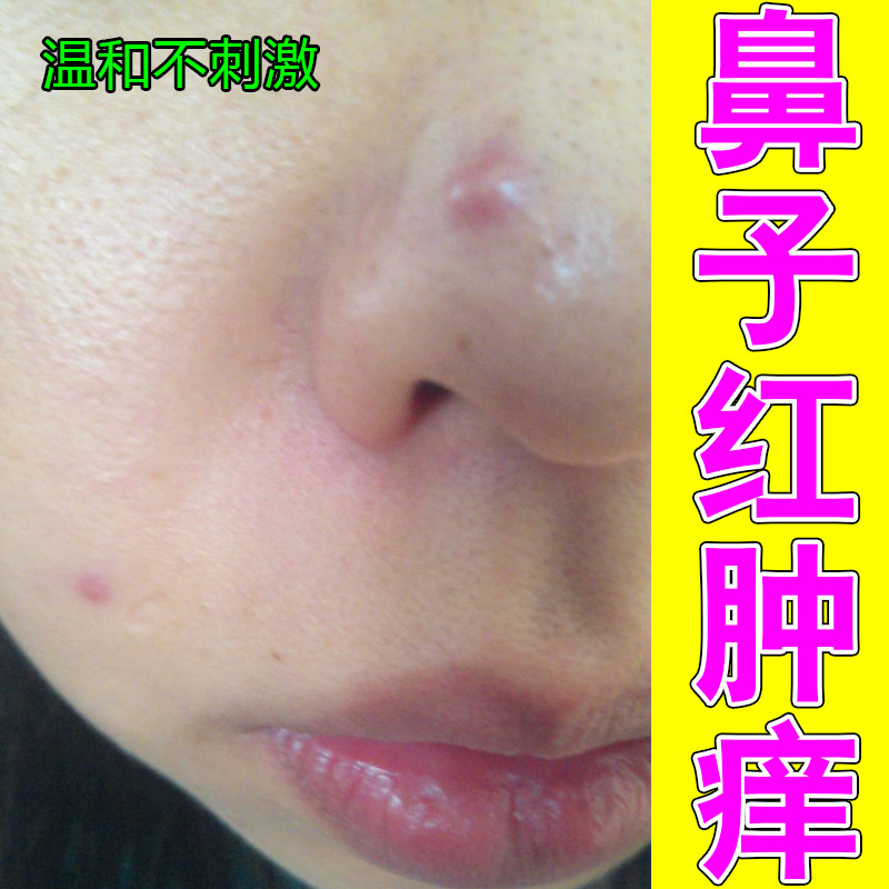 鼻子红肿痒鼻周两侧泛红干燥痒掉皮肤消毒护理（消）