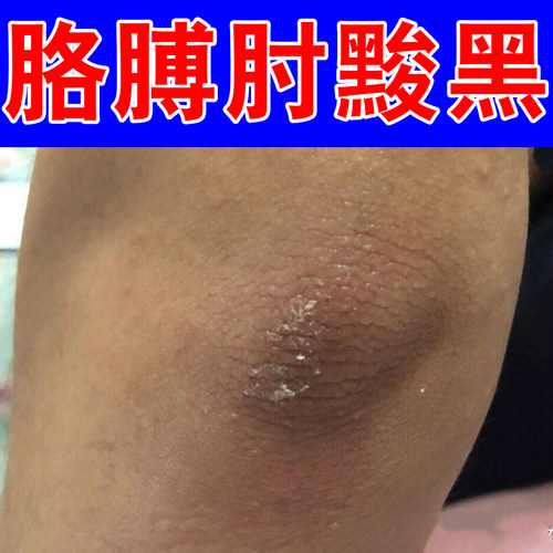 胳膊肘黢黑脖子黑洗不干净皮肤干燥粗糙掉屑去死皮黑色素沉淀专用