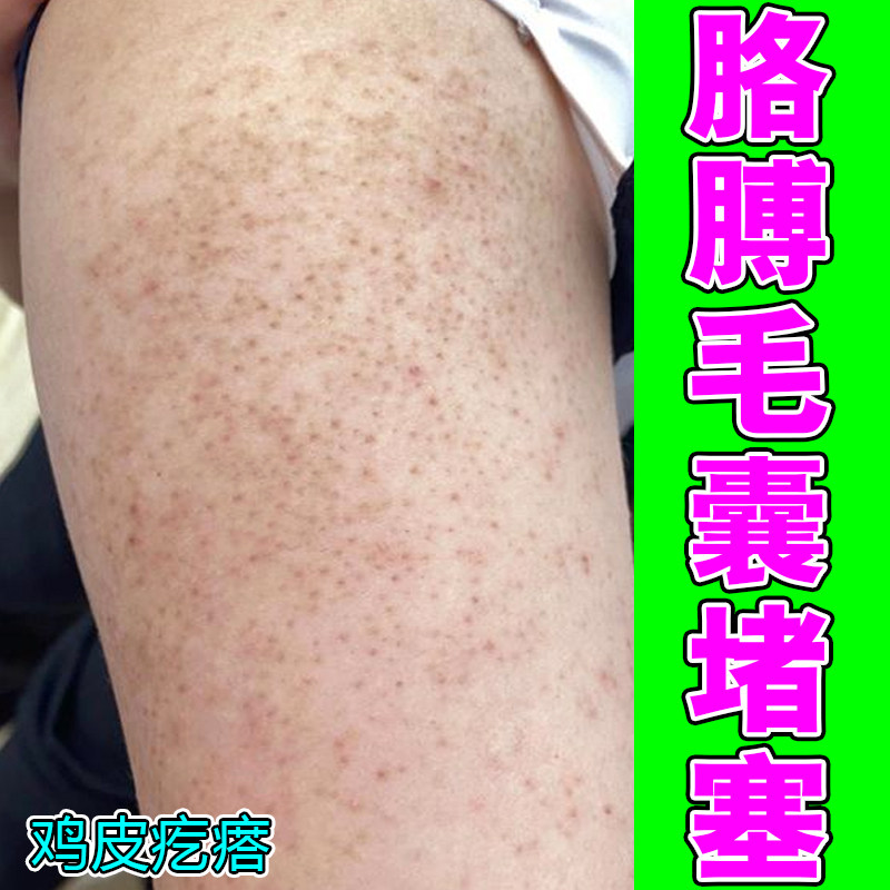 腿上皮毛囊胳膊上小疙瘩毛孔粗大皮肤消毒护理（消）