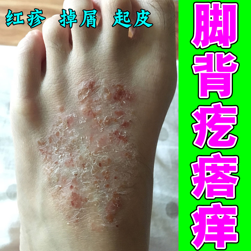 冶疗脚背粗糙痒手足长红疙瘩起红斑水泡掉屑药乳