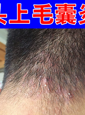 头上毛囊头部痒有红疙瘩脓包疙瘩脂溢干燥粗糙头油螨虫保药