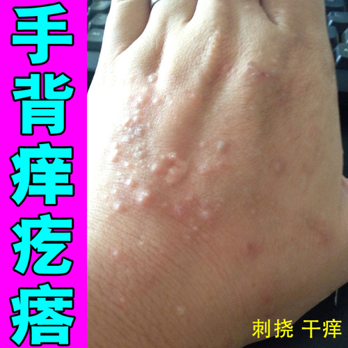 手背痒疙瘩皮肤过敏裂身上胳膊腿上长红点痒手背痘痘痒膏