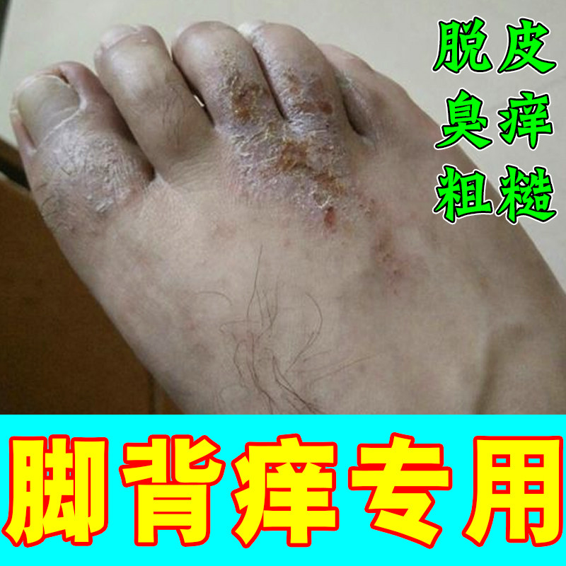 冶疗脚背痒脚趾脚底板长水泡皮肤干燥粗糙鳞屑角质增厚专用修复药