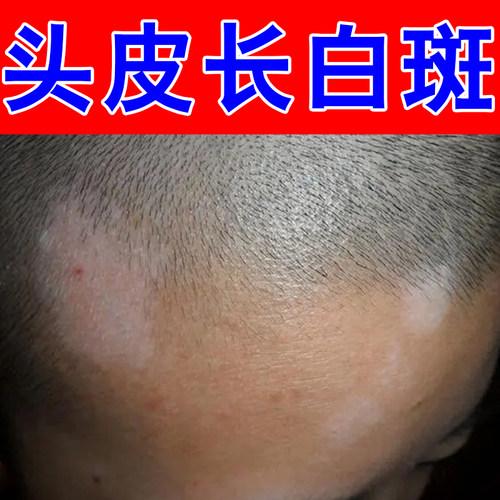头皮长白斑掉屑红肿脖子后面长白点皮肤粗糙腋下汗斑外用修护药乳