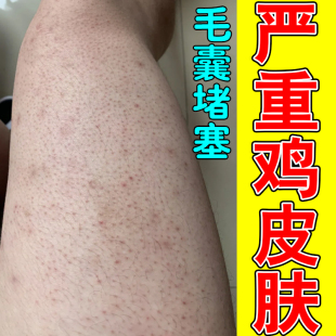 皮肤疙瘩毛囊角化儿童胳膊小臂腿上长丘颗粒摸起来粗糙修复药