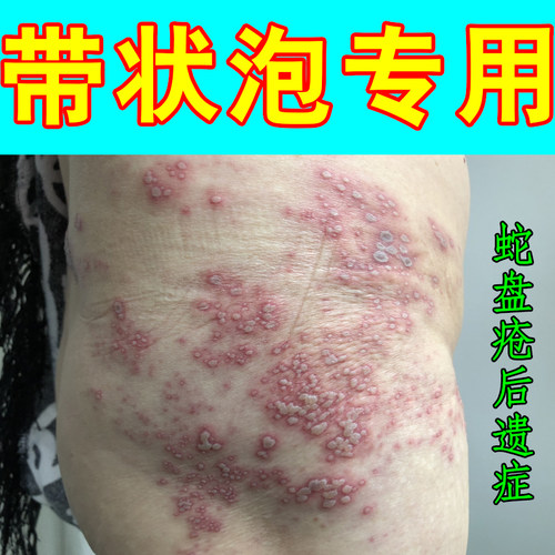 蛇盘疮专用蛇缠腰带状泡蜘蛛疮药