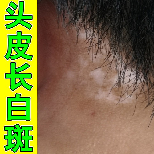 头皮长白斑脖子后面长白点汗斑褐色斑点黑色素缺失儿童成人通用药