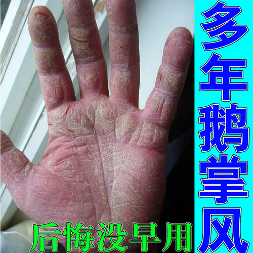 顽固手脱皮干裂真菌感染鹅掌风手指裂口长茧硬疙瘩痒长水泡神器膏
