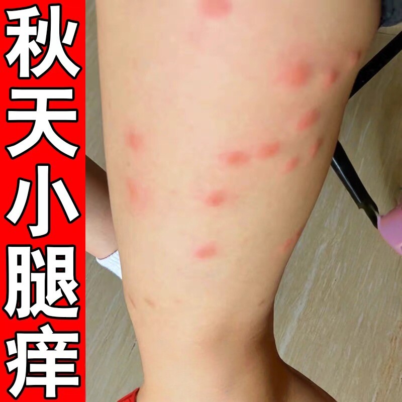 秋季腿痒小腿皮肤痒腿上起疙瘩红皮肤消毒护理（消）