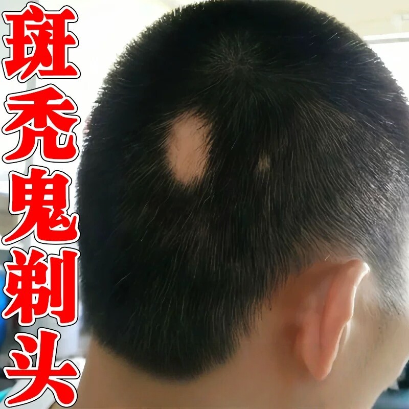 鬼剃头特效药斑秃后脑勺块状脱发毛囊受损修护脱生发育发专用喷剂