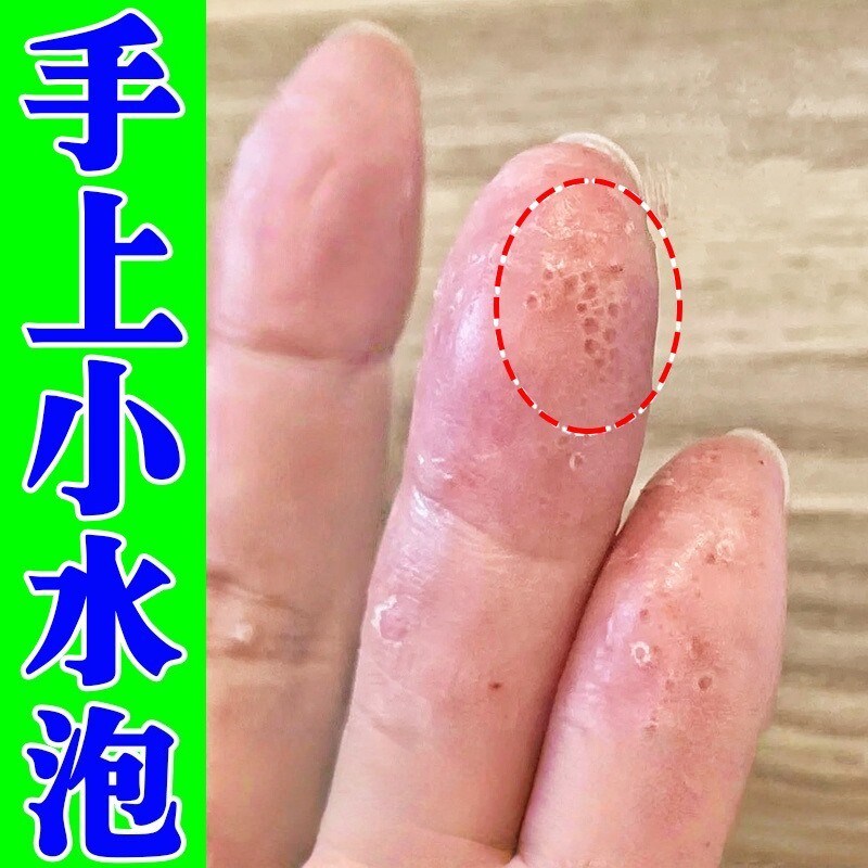 手上起小水泡痒汗泡疱手指手背感染干燥粗糙鹅掌有风外用修复膏