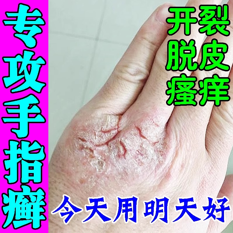 手指关节藓手藓膏真菌感染脱皮干裂增厚脱屑硬皮手指关节长硬疙瘩