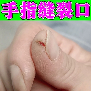 治手裂的药膏手裂口干裂修复霜指甲缝开裂脱皮疼干燥粗糙滋润软膏