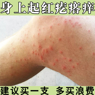 身上皮肤痒秋冬季后背手臂大腿干痒起红疙瘩长小红点皮肤过敏软膏
