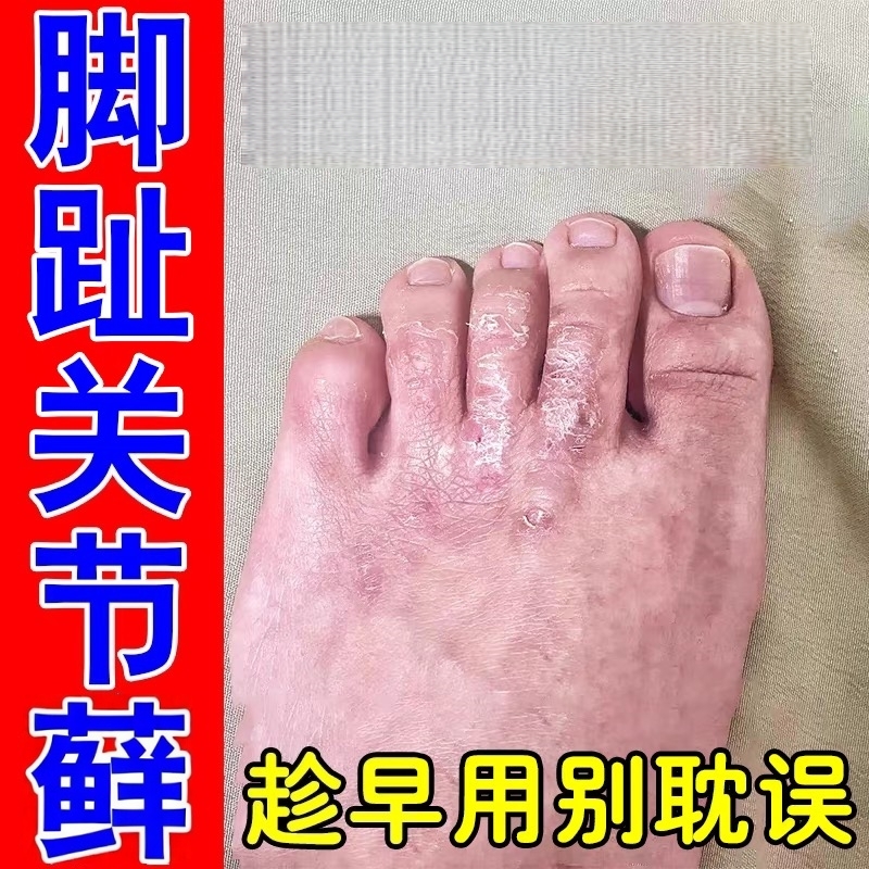 脚趾头长藓脚背发痒脚指关节鲜痒刺挠干燥起皮脚趾脱皮足鲜专用膏