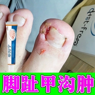 甲沟长息肉去除指甲长肉里消肿化脓大拇指脚趾嵌甲肉芽化脓肿疼痛