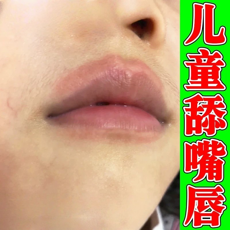 儿童舔嘴唇嘴巴一圈红痒修复羊胡子疮肿疼痛唇炎干燥起皮专用药膏