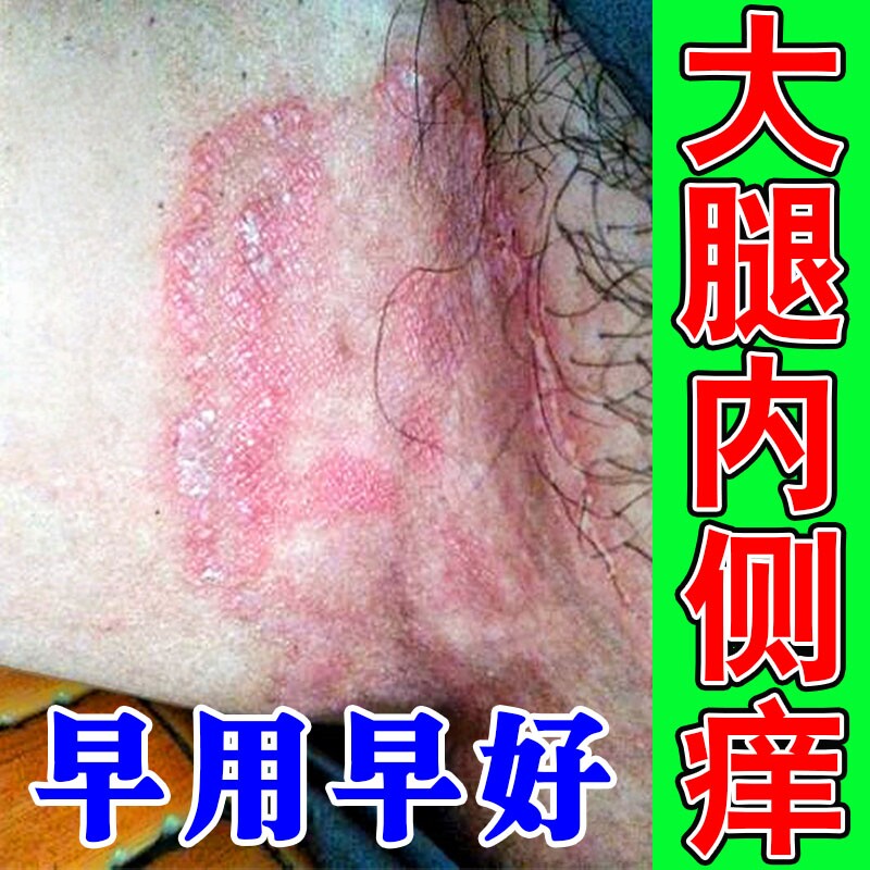 大腿内侧潮湿发痒大腿根两侧干痒长红斑起皮越挠越痒男女通用乳膏
