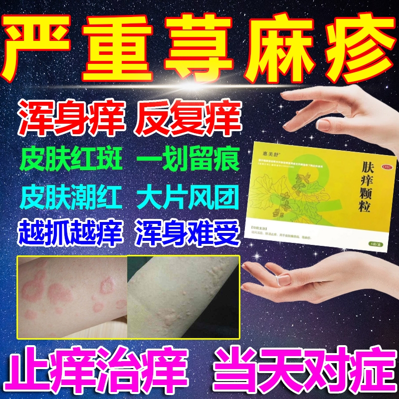 肤痒颗粒正品中成药治疗荨麻疹湿疹过敏皮炎症皮肤搔痒除湿止痒药