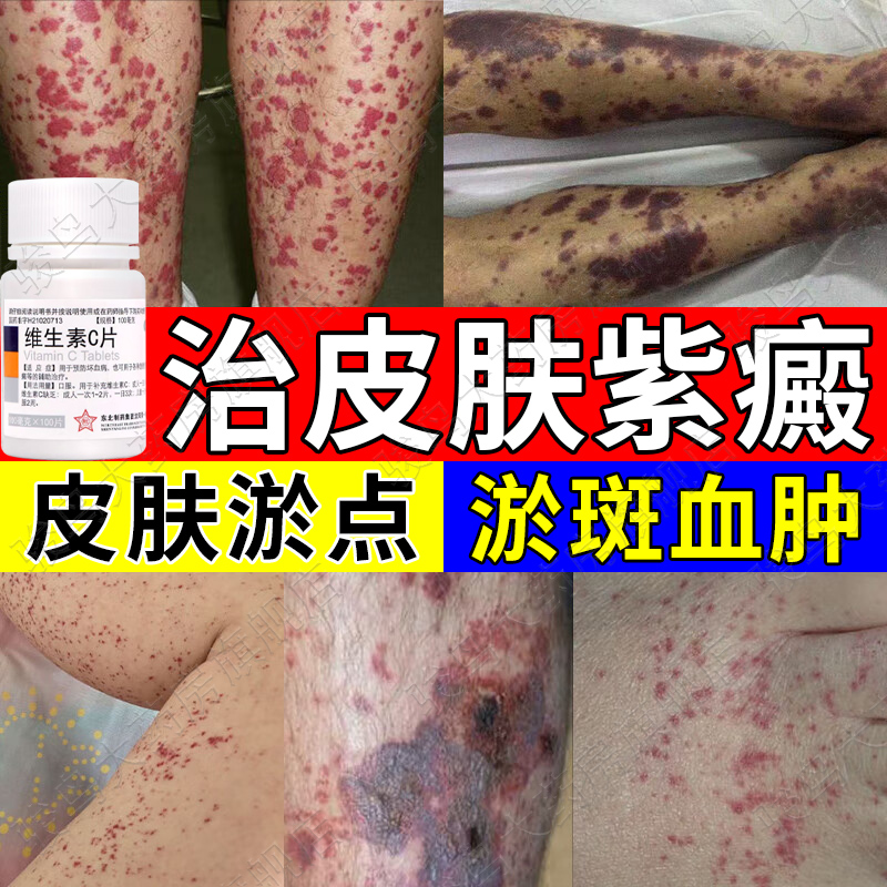 【东北制药】维生素C片100mg*100片/瓶