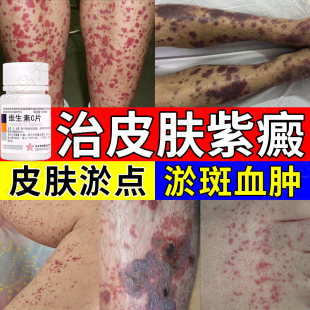 治疗过敏性紫癜皮下出血特严重瘀斑血肿专效口服药维生素C片正品