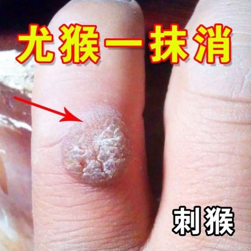 五伍妙水仙膏混悬剂水仙五伍秒庙妙正品非国药正品准字