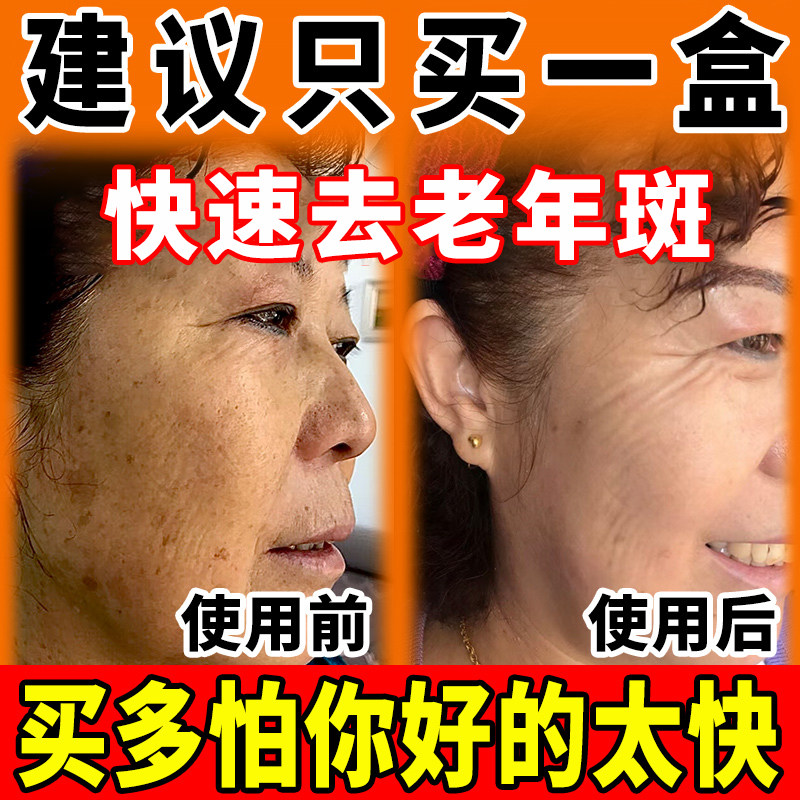 老年斑强力祛斑霜黄褐斑雀斑老人手部脸部去除专用男官方正品