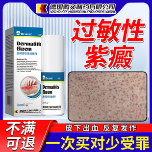 过敏性紫癜皮下出血红点瘀紫癜性皮炎血管炎血斑色素性斑块HA