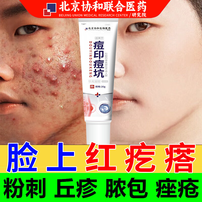 脸上起红疙瘩闭口粉刺的克星脸上起小疙瘩去除脸部痘印痘坑痤疮kp