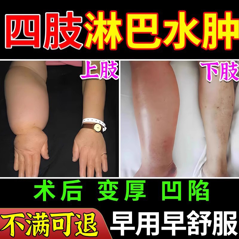 四肢淋巴水肿消肿专术后上肢下肢淋巴水肿用涂抹膏大腿浮肿康复ZR